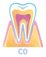 虫歯の初期段階「C0」