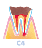 歯の頭の部分もほぼ無くなり根っこだけになってしまった段階「C4」