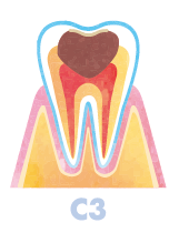 歯の神経まで虫歯が到達してしまった段階「C3」