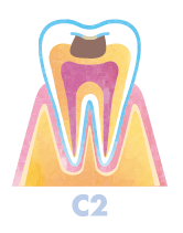 象牙質まで虫歯が進んでしまった段階「C2」