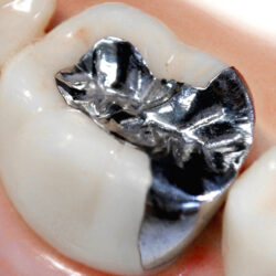 昔治療した銀歯はとったほうがいいですか？｜青葉台の歯医者・歯科