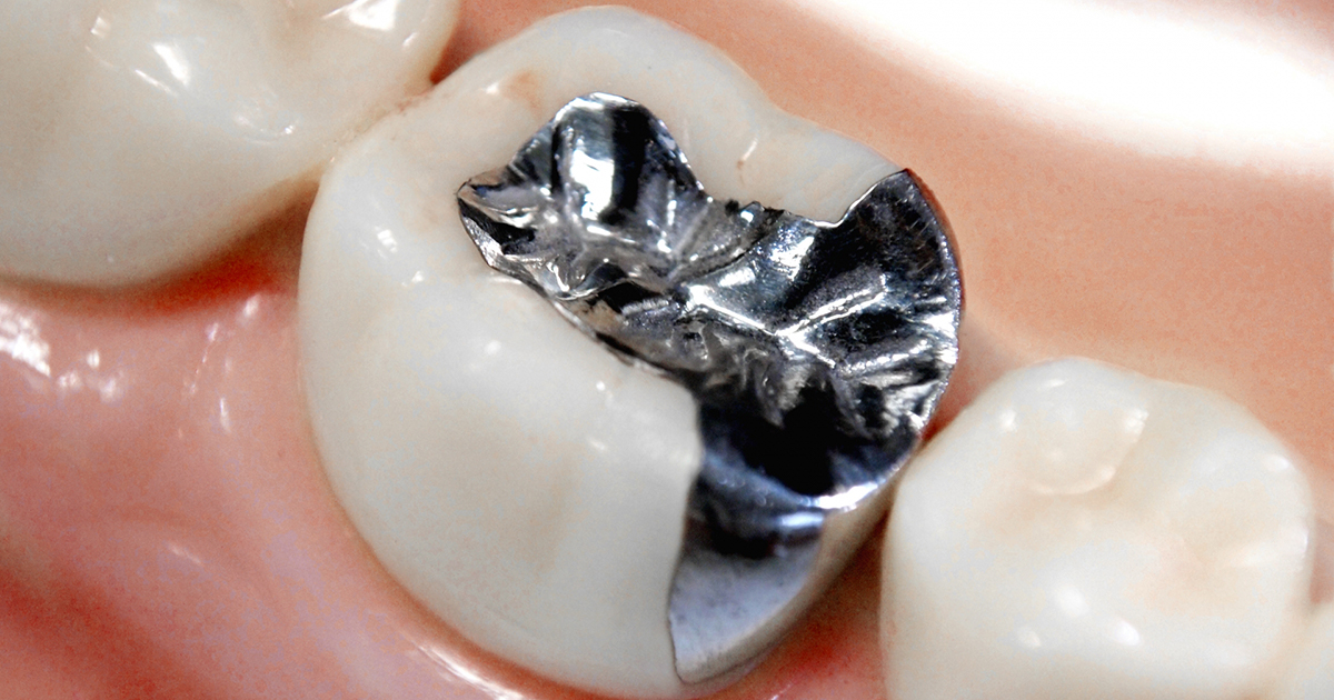 銀歯11g ed9058a131dfb334021278673c04de