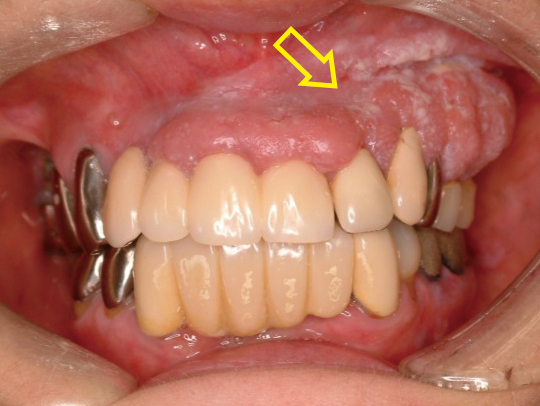 口唇がんの段階